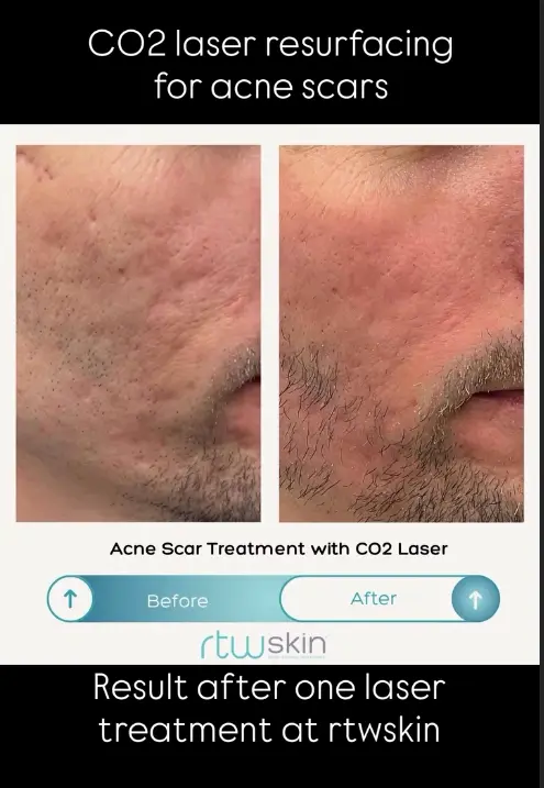Side-by-side photos showing reduced acne scarring on a man’s cheek after one CO2 laser treatment