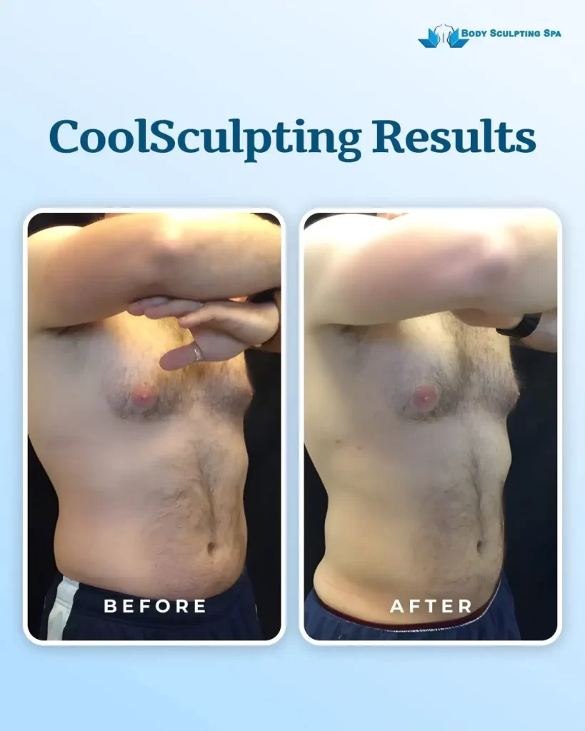 Side-by-side photos of a man’s torso showing visible fat reduction after CoolSculpting